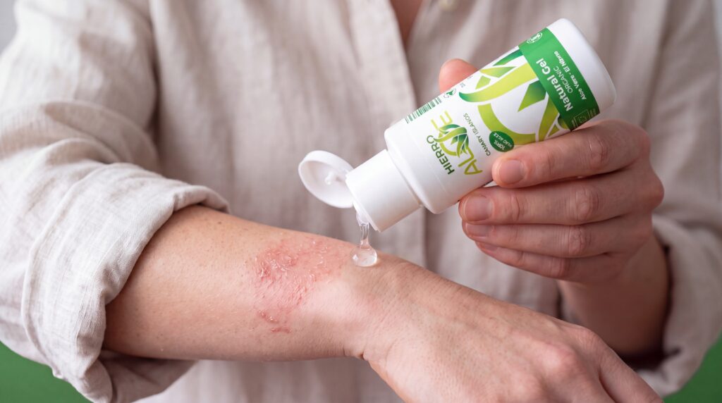 eczemas y quemaduras, tratamiento gel natural de aloe vera